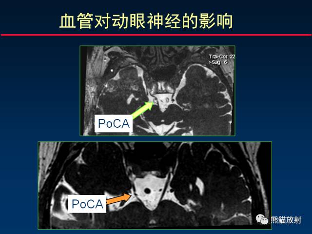 【柳澄讲坛】MR新技术在颅神经研究中的应用