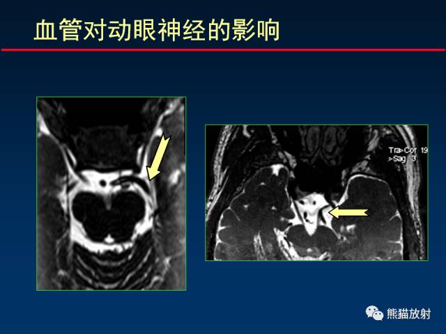 【柳澄讲坛】MR新技术在颅神经研究中的应用