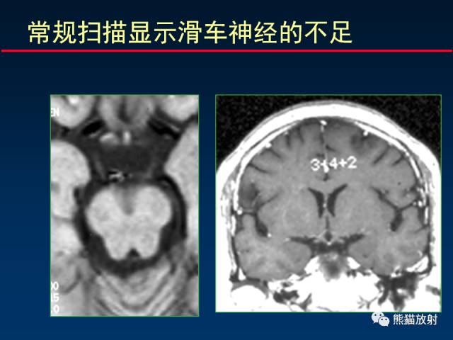 【柳澄讲坛】MR新技术在颅神经研究中的应用