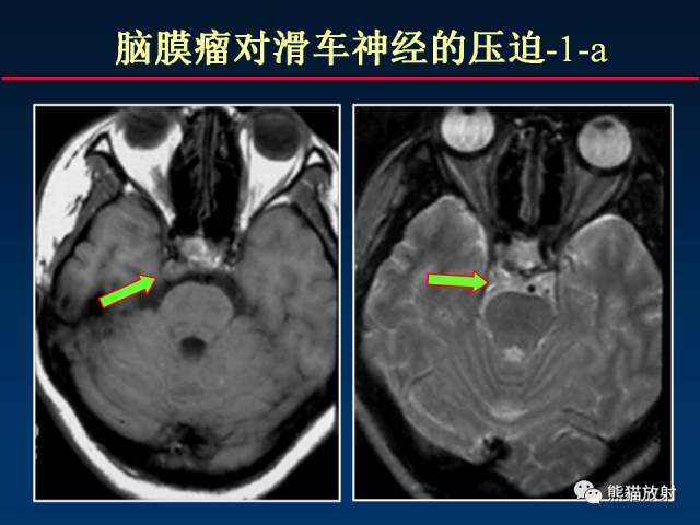 【柳澄讲坛】MR新技术在颅神经研究中的应用