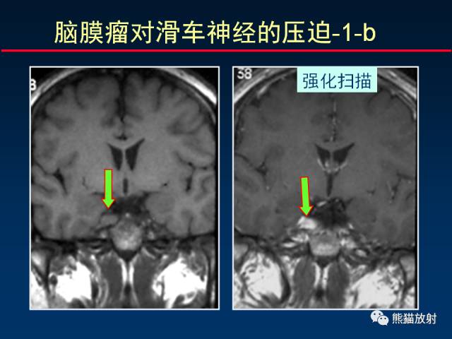 【柳澄讲坛】MR新技术在颅神经研究中的应用
