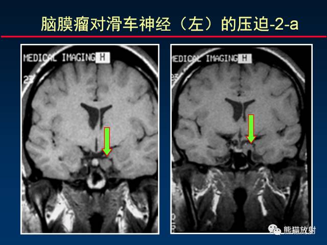 【柳澄讲坛】MR新技术在颅神经研究中的应用