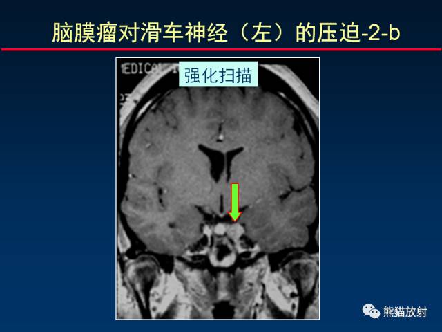 【柳澄讲坛】MR新技术在颅神经研究中的应用