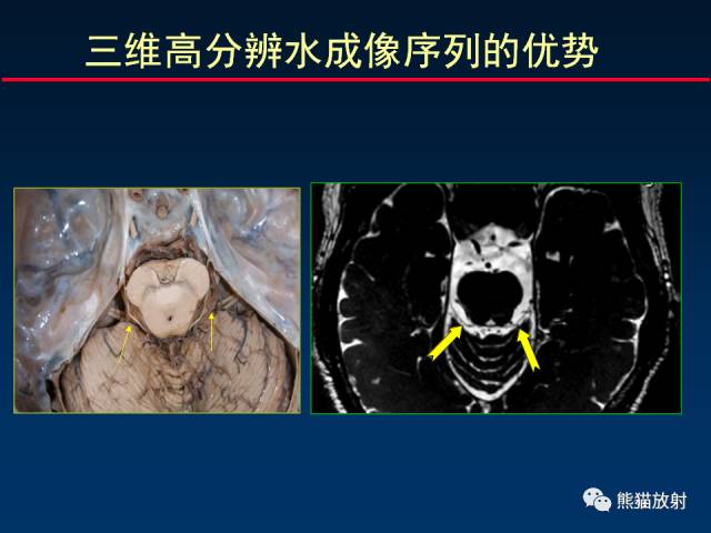 【柳澄讲坛】MR新技术在颅神经研究中的应用