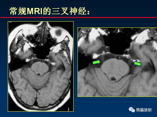 【柳澄讲坛】MR新技术在颅神经研究中的应用