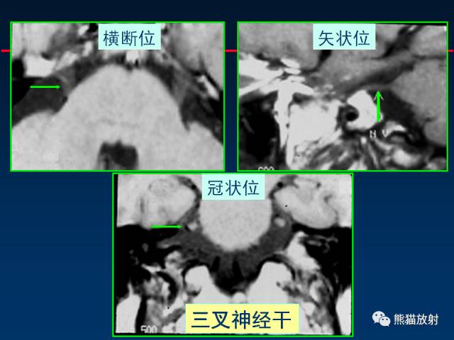 【柳澄讲坛】MR新技术在颅神经研究中的应用