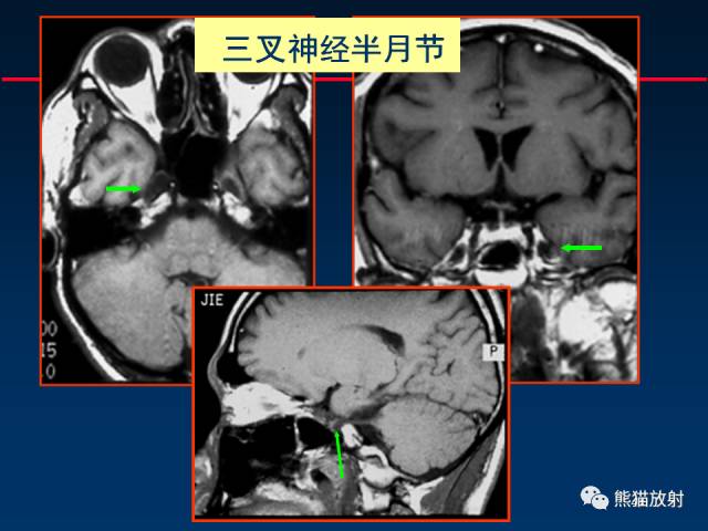 【柳澄讲坛】MR新技术在颅神经研究中的应用