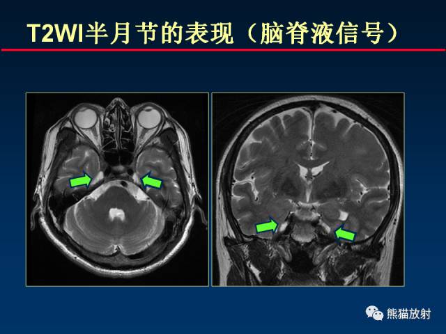 【柳澄讲坛】MR新技术在颅神经研究中的应用