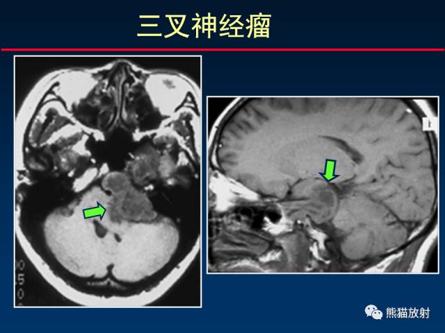 【柳澄讲坛】MR新技术在颅神经研究中的应用