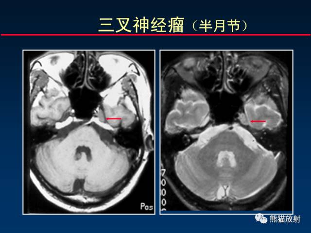 【柳澄讲坛】MR新技术在颅神经研究中的应用