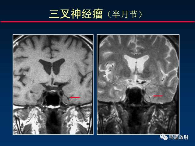【柳澄讲坛】MR新技术在颅神经研究中的应用