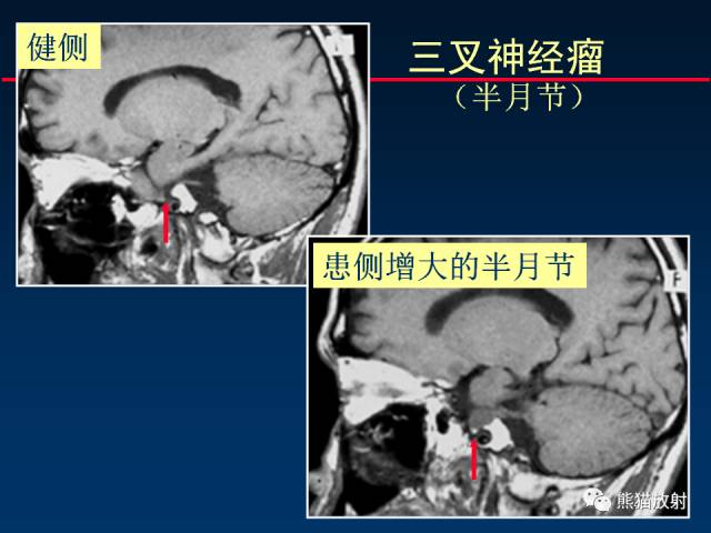 【柳澄讲坛】MR新技术在颅神经研究中的应用