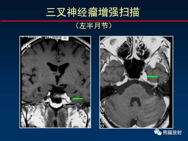 【柳澄讲坛】MR新技术在颅神经研究中的应用