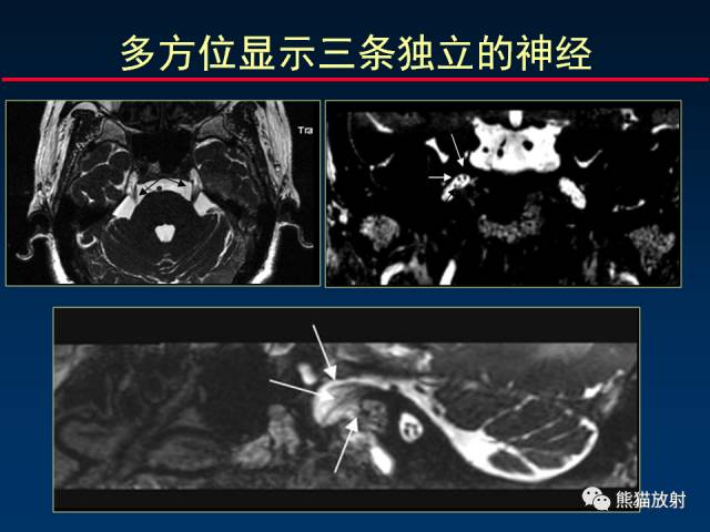 【柳澄讲坛】MR新技术在颅神经研究中的应用