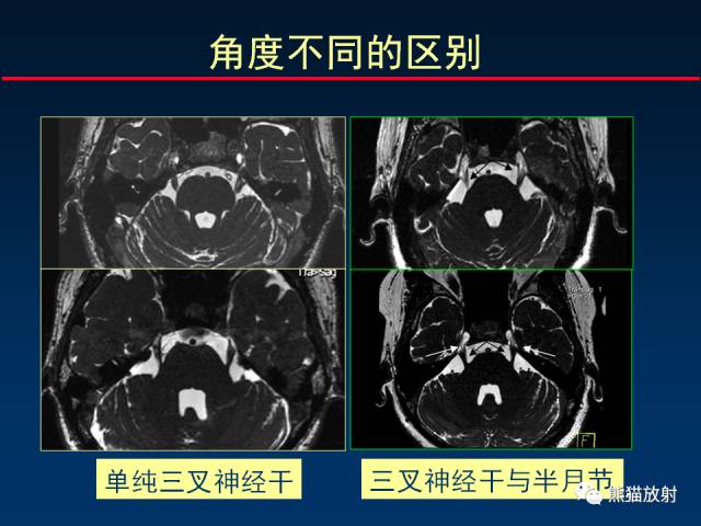 【柳澄讲坛】MR新技术在颅神经研究中的应用