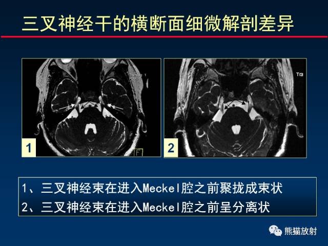 【柳澄讲坛】MR新技术在颅神经研究中的应用
