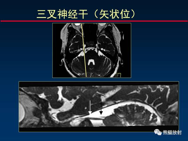 【柳澄讲坛】MR新技术在颅神经研究中的应用