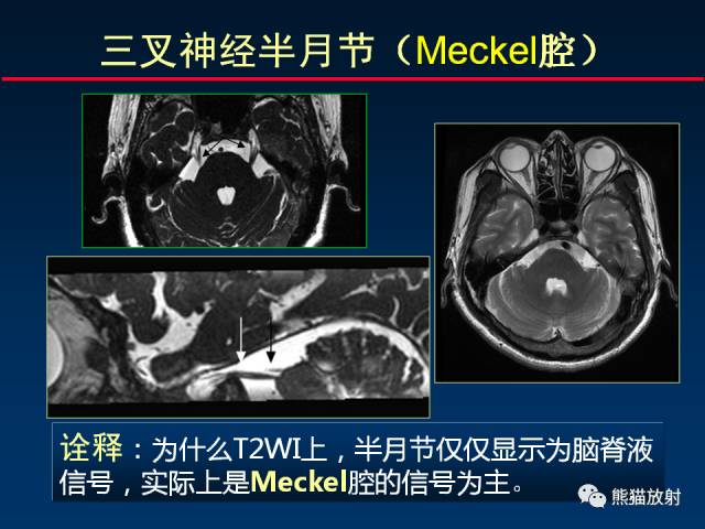 【柳澄讲坛】MR新技术在颅神经研究中的应用