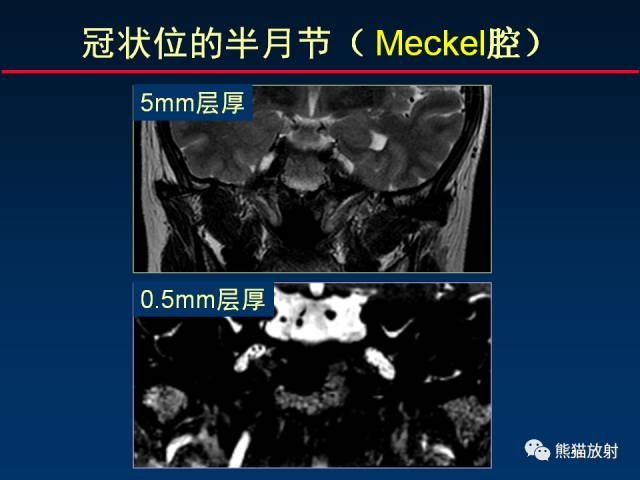 【柳澄讲坛】MR新技术在颅神经研究中的应用