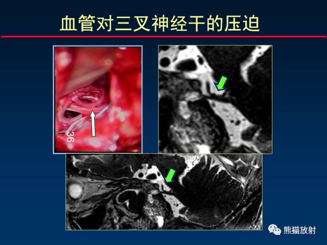 【柳澄讲坛】MR新技术在颅神经研究中的应用
