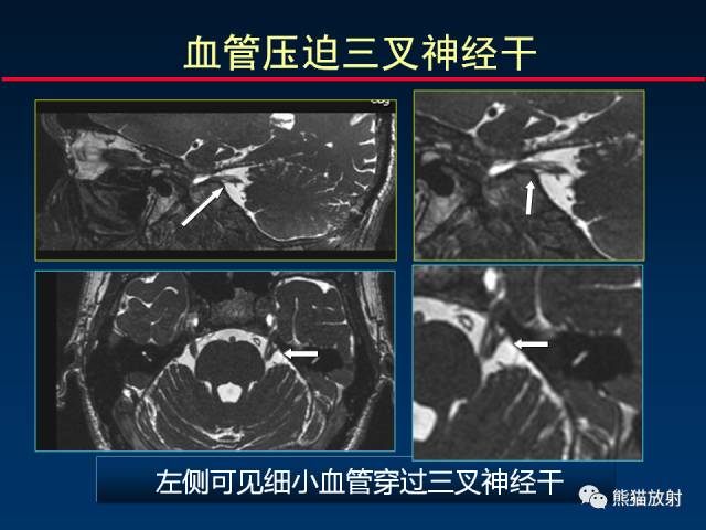 【柳澄讲坛】MR新技术在颅神经研究中的应用