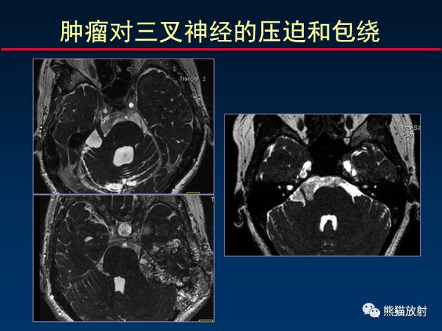 【柳澄讲坛】MR新技术在颅神经研究中的应用