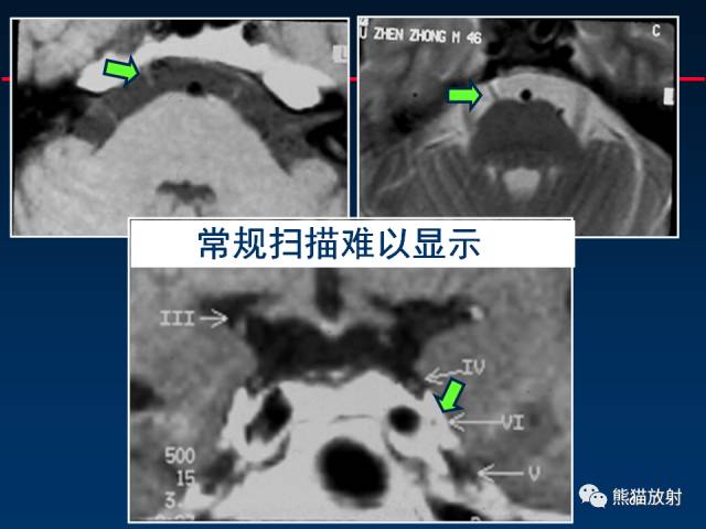 【柳澄讲坛】MR新技术在颅神经研究中的应用