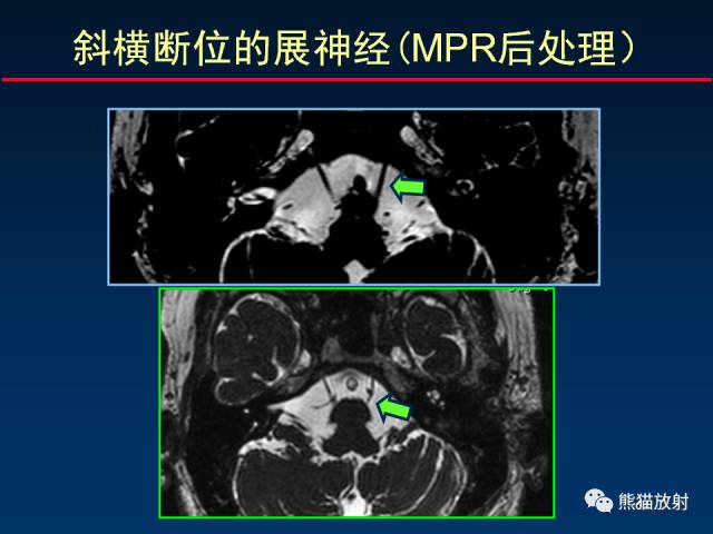 【柳澄讲坛】MR新技术在颅神经研究中的应用
