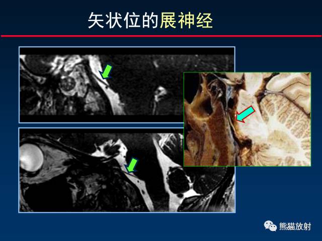 【柳澄讲坛】MR新技术在颅神经研究中的应用