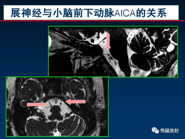 【柳澄讲坛】MR新技术在颅神经研究中的应用