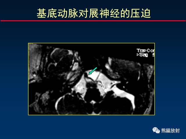 【柳澄讲坛】MR新技术在颅神经研究中的应用