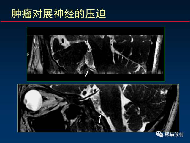 【柳澄讲坛】MR新技术在颅神经研究中的应用