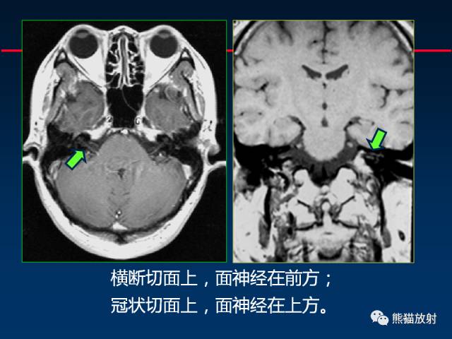 【柳澄讲坛】MR新技术在颅神经研究中的应用