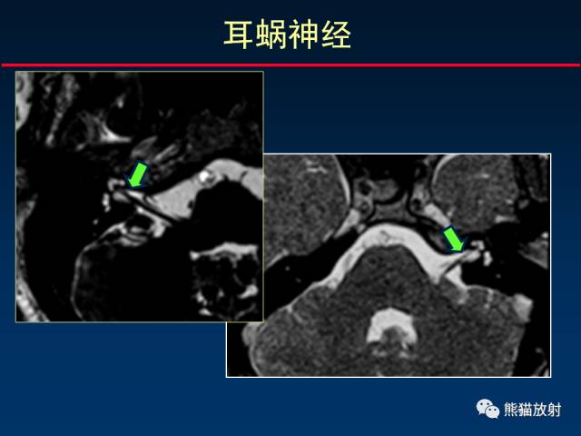 【柳澄讲坛】MR新技术在颅神经研究中的应用