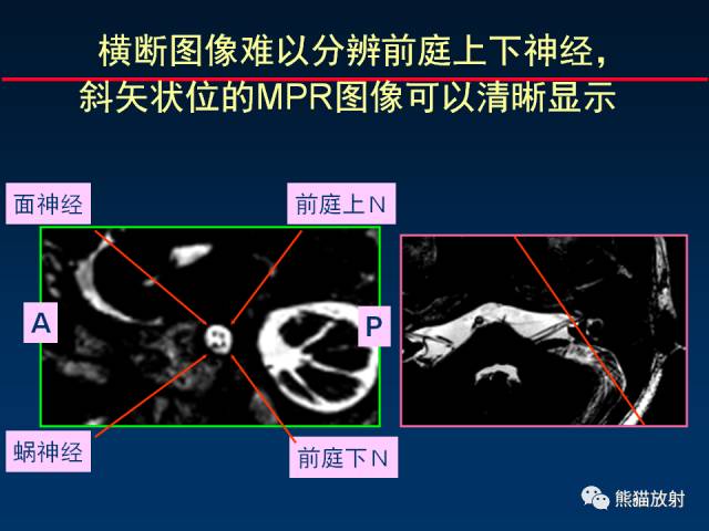 【柳澄讲坛】MR新技术在颅神经研究中的应用