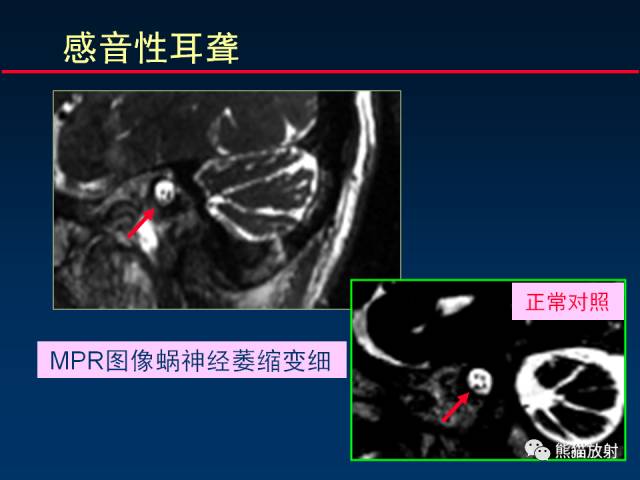 【柳澄讲坛】MR新技术在颅神经研究中的应用