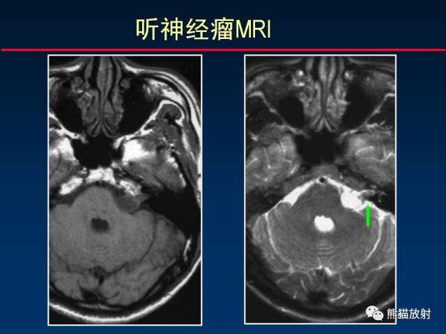 【柳澄讲坛】MR新技术在颅神经研究中的应用