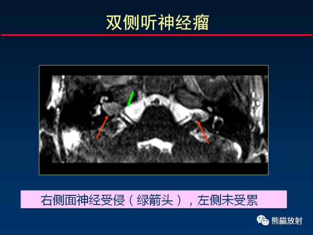 【柳澄讲坛】MR新技术在颅神经研究中的应用
