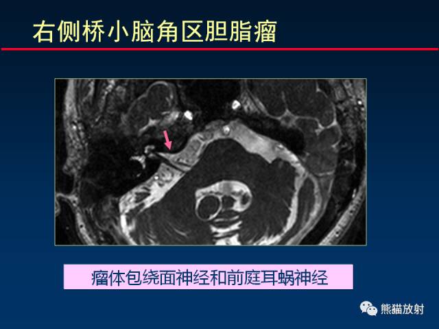 【柳澄讲坛】MR新技术在颅神经研究中的应用