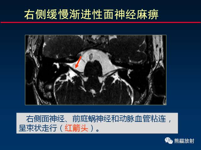 【柳澄讲坛】MR新技术在颅神经研究中的应用