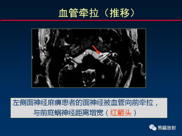 【柳澄讲坛】MR新技术在颅神经研究中的应用