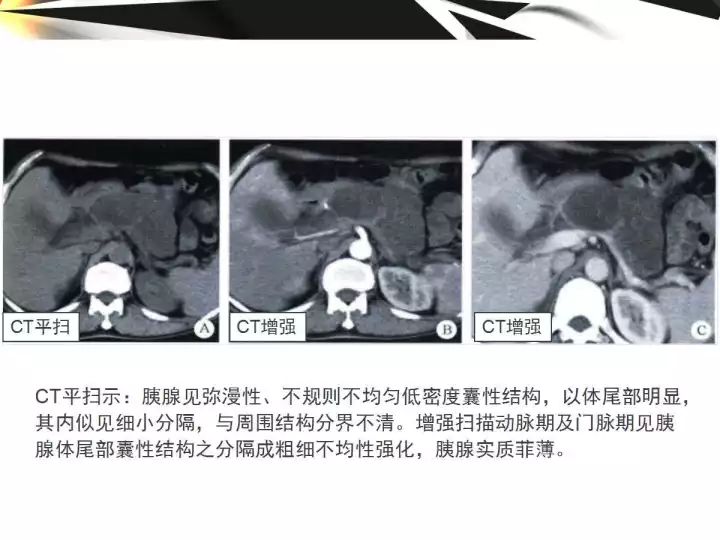 【病例】胰腺导管内乳头状粘液囊腺癌1例CT