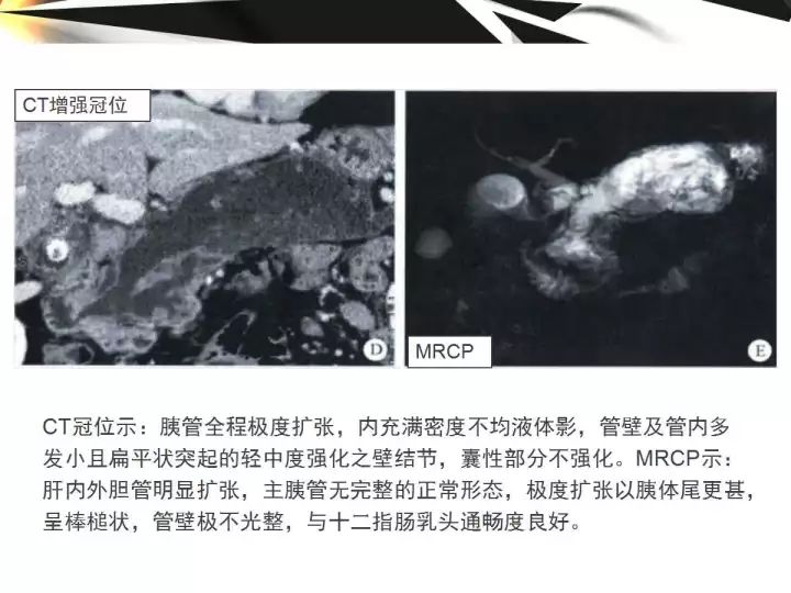 【病例】胰腺导管内乳头状粘液囊腺癌1例CT