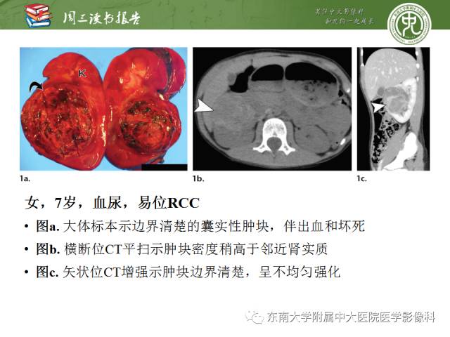 【PPT】儿童肾肿瘤：影像-病理相关性第二部分（10 ~ 20岁）