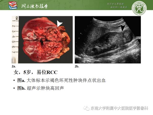 【PPT】儿童肾肿瘤：影像-病理相关性第二部分（10 ~ 20岁）