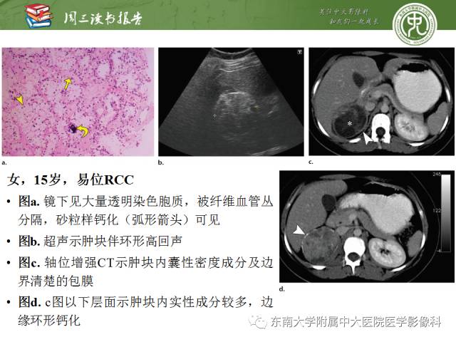 【PPT】儿童肾肿瘤：影像-病理相关性第二部分（10 ~ 20岁）