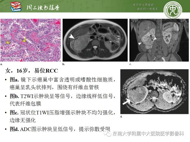 【PPT】儿童肾肿瘤：影像-病理相关性第二部分（10 ~ 20岁）