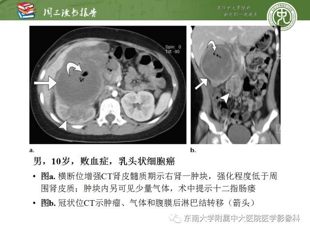 【PPT】儿童肾肿瘤：影像-病理相关性第二部分（10 ~ 20岁）