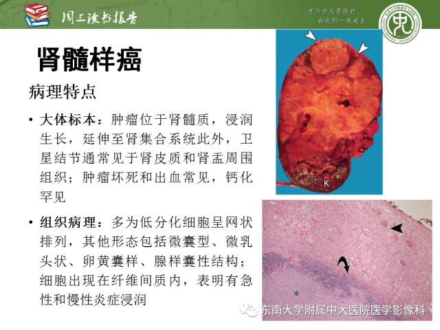 【PPT】儿童肾肿瘤：影像-病理相关性第二部分（10 ~ 20岁）