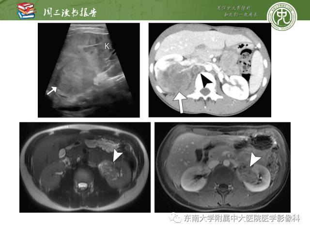 【PPT】儿童肾肿瘤：影像-病理相关性第二部分（10 ~ 20岁）